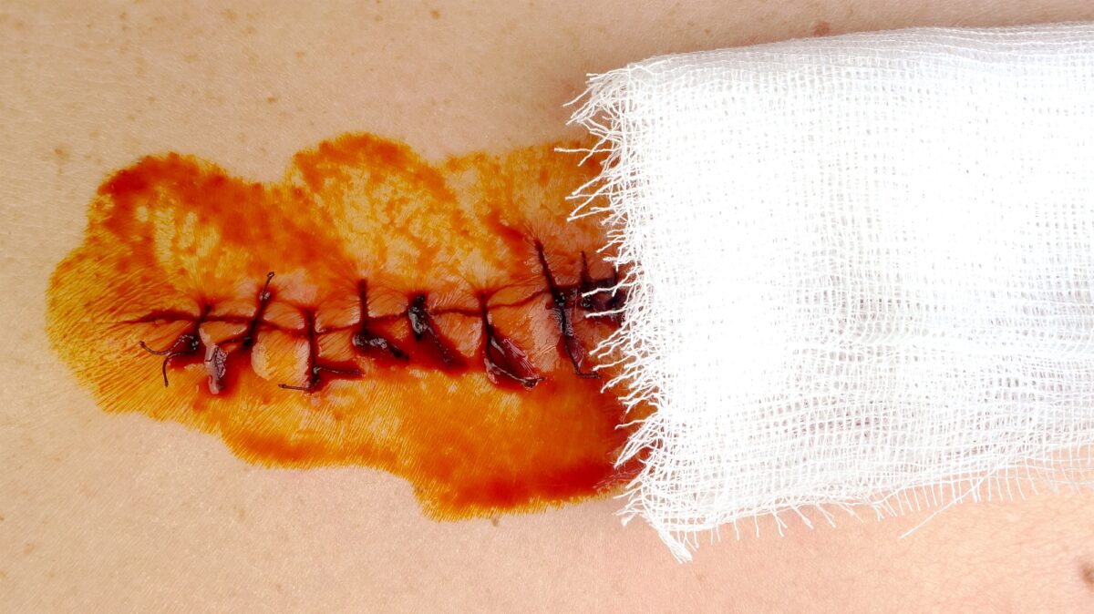 Medical sutures, stitch after surgery, stitched surgical sutures on human body smeared betadine.