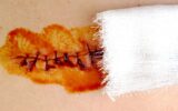 Medical sutures, stitch after surgery, stitched surgical sutures on human body smeared betadine.
