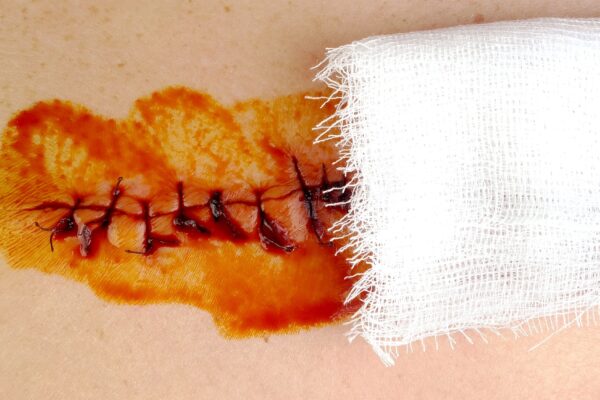 Medical sutures, stitch after surgery, stitched surgical sutures on human body smeared betadine.