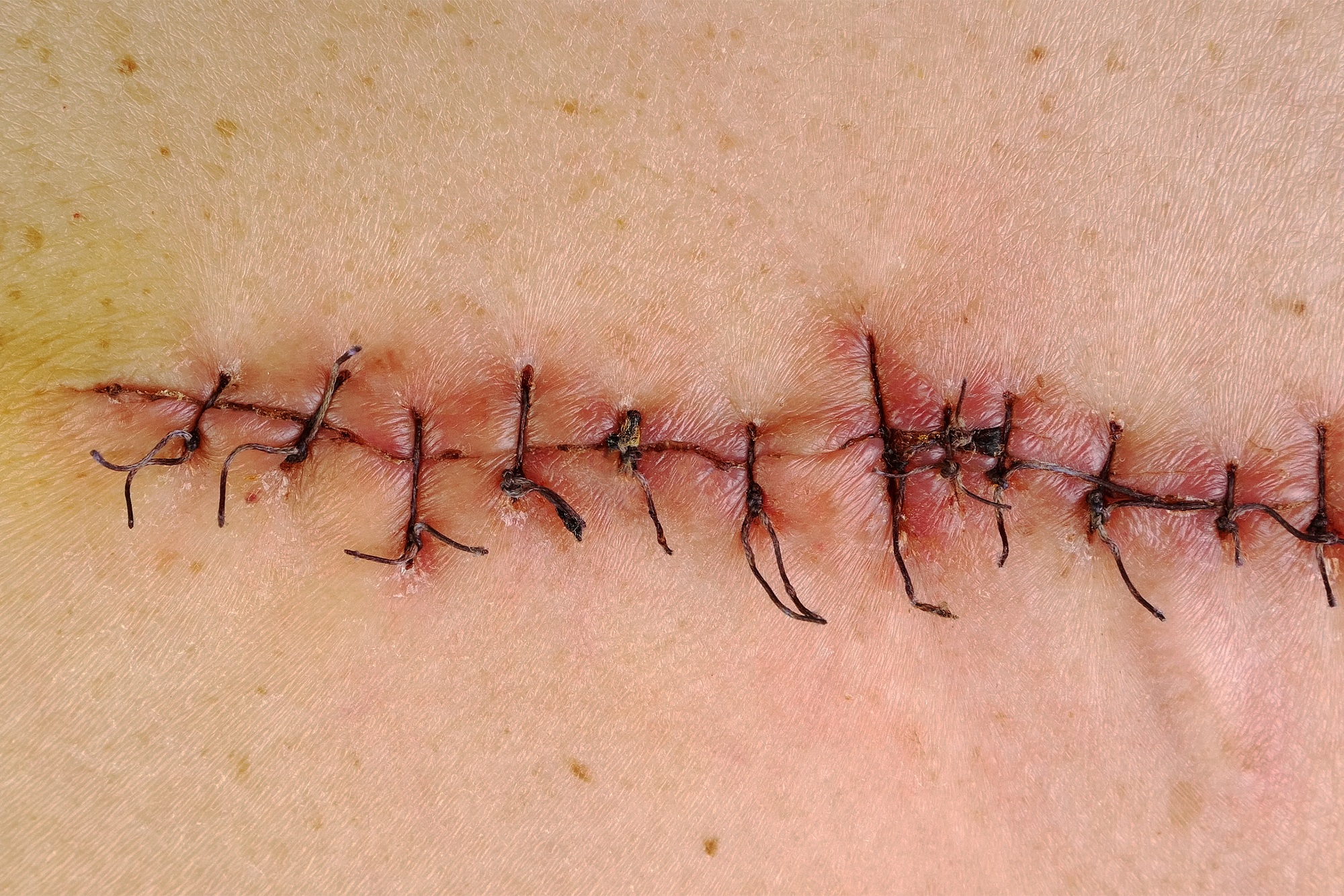 Medical sutures, stitches after surgery, stitched surgical sutures on human body.